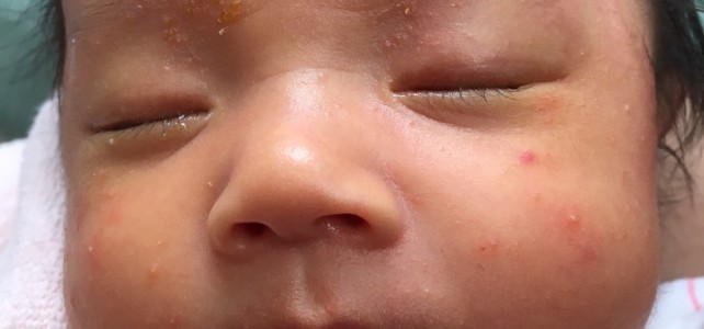 乳児湿疹、原因は母乳?! 乳児湿疹、原因は母乳?!